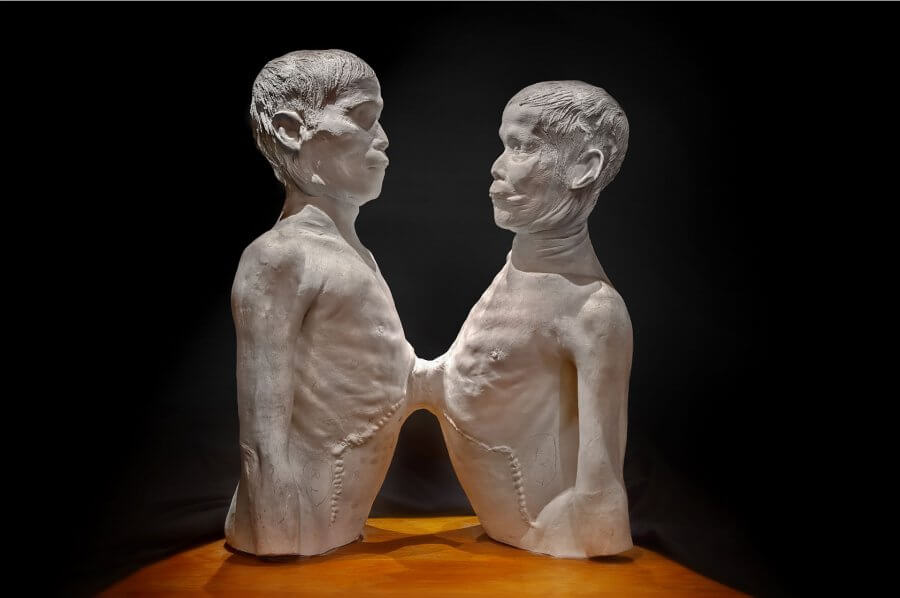 Сиамские близнецы в музее Мюттера
